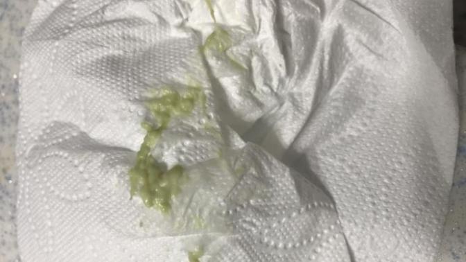 Yeşil akıntı ve idrarın renginin yeşil olması?