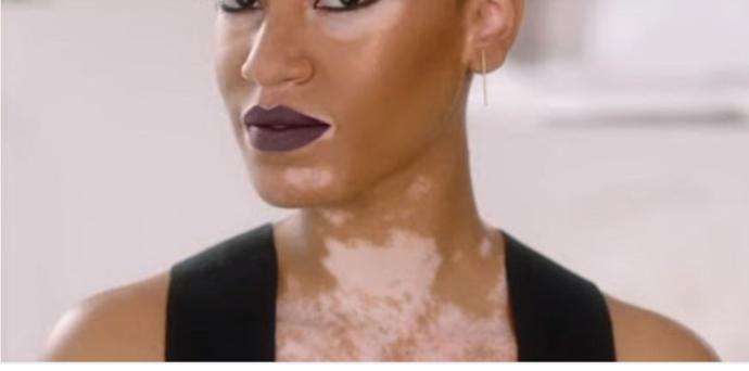 Vitiligo cilt hastalığı