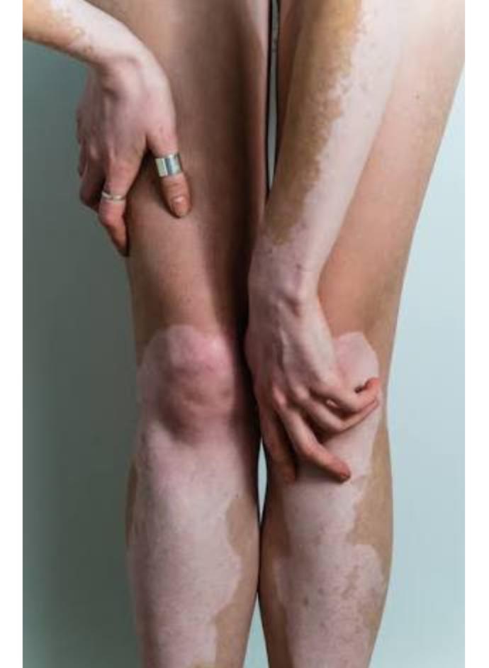 Vitiligo cilt hastalığı