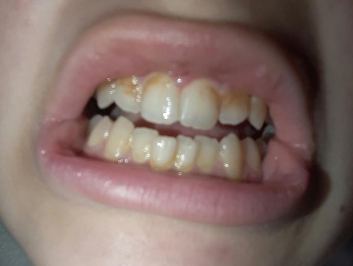 Dişlerim hem sarı hemde yamuk. Beyazlatmayla nasıl olur?
