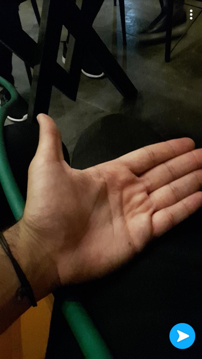Ellerim neden tombik arkadaşlar?