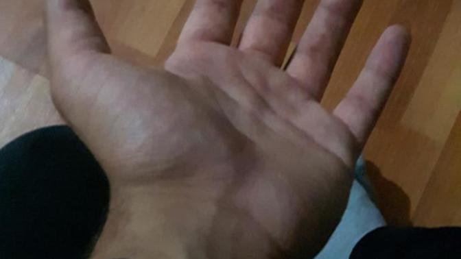 Ellerim neden tombik arkadaşlar?