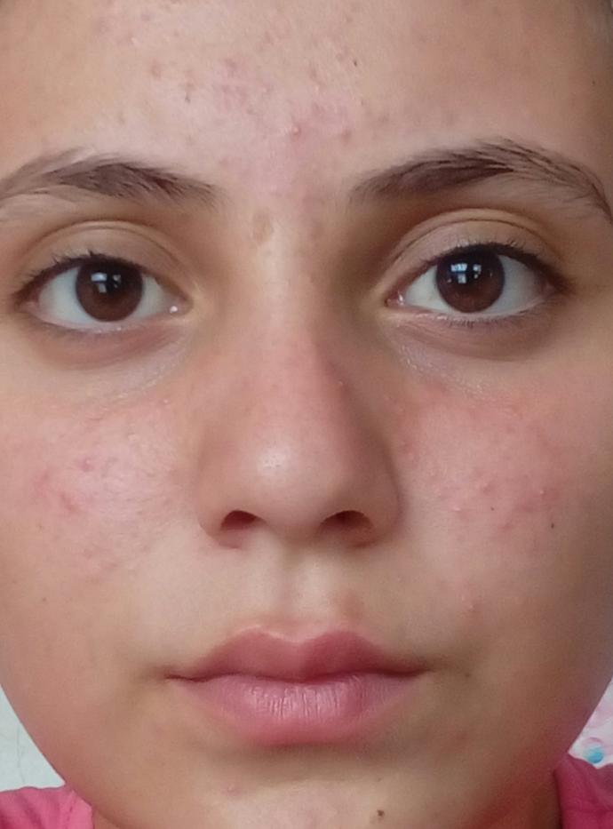 Neden bu kadar çirkinim? Bunların geçmesi için ne yapmam lazım?(RESİMLİ) Yardım lütfen?