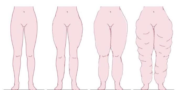 Lipedema thesis konuldu :(?