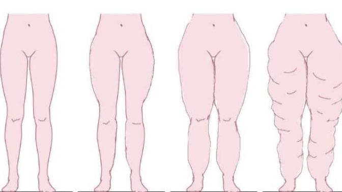 Lipedema thesis konuldu :(?